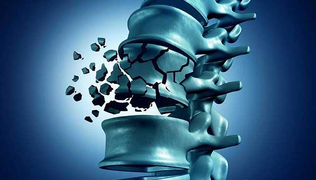 https://biosuticks.com/wp-content/uploads/2025/04/osteoporosis.jpg